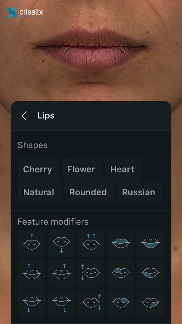 Simulation 3D des visages dans l’application Crisalix avec l’outil de procédure « Lips » ouvert. 1080px x 1920px.