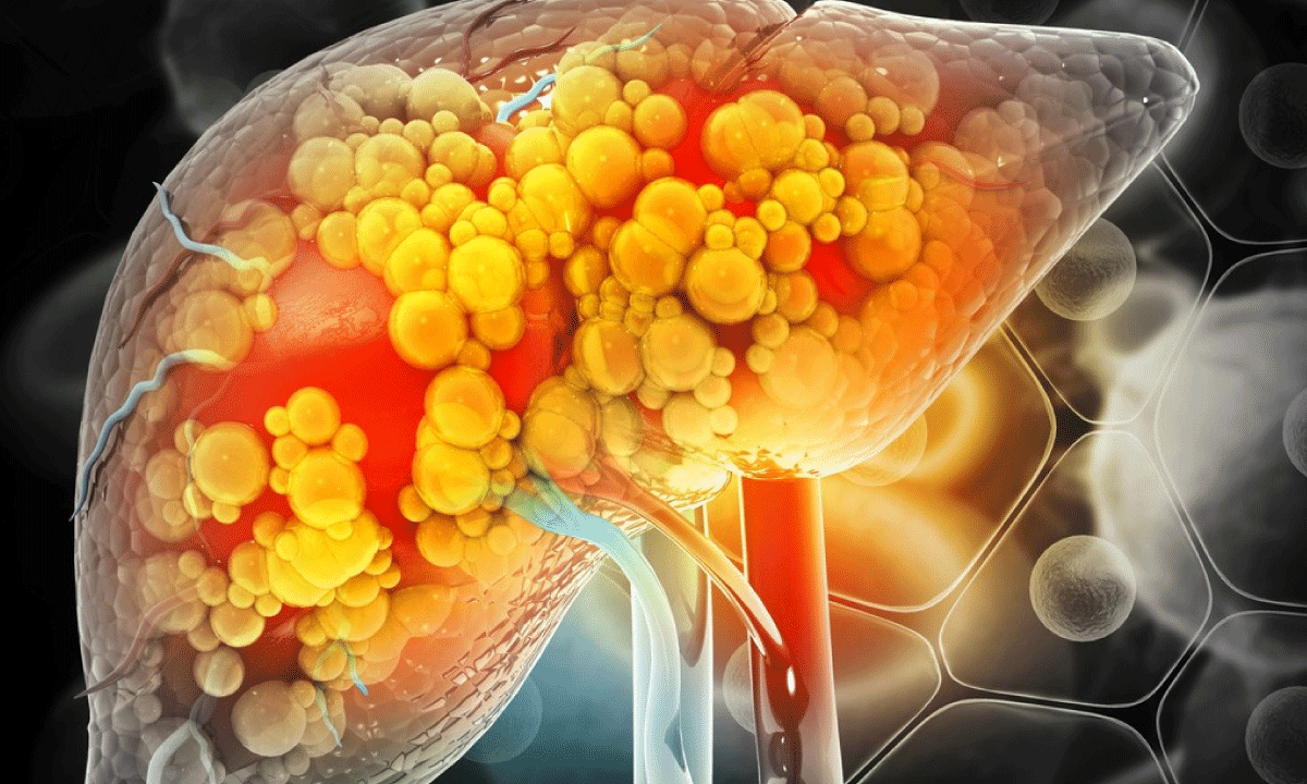 Las señales que advierten sobre hígado graso: Lo que recomienda un médico de Harvard