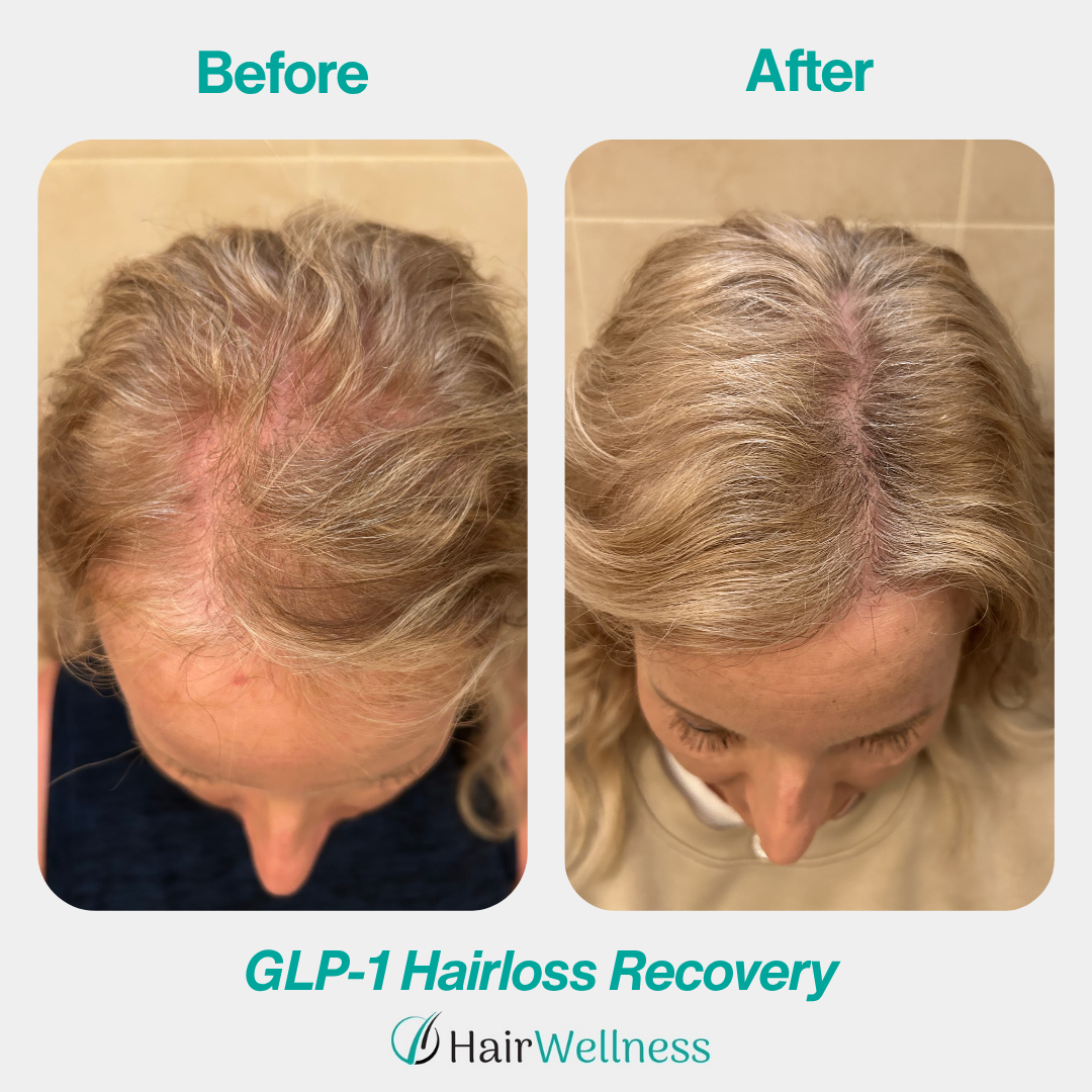 Telogen effluvium treatment result