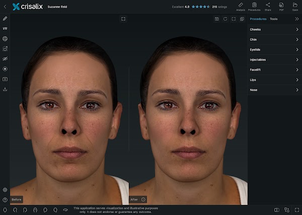 Simulation 3D des visages dans l’application Crisalix.
