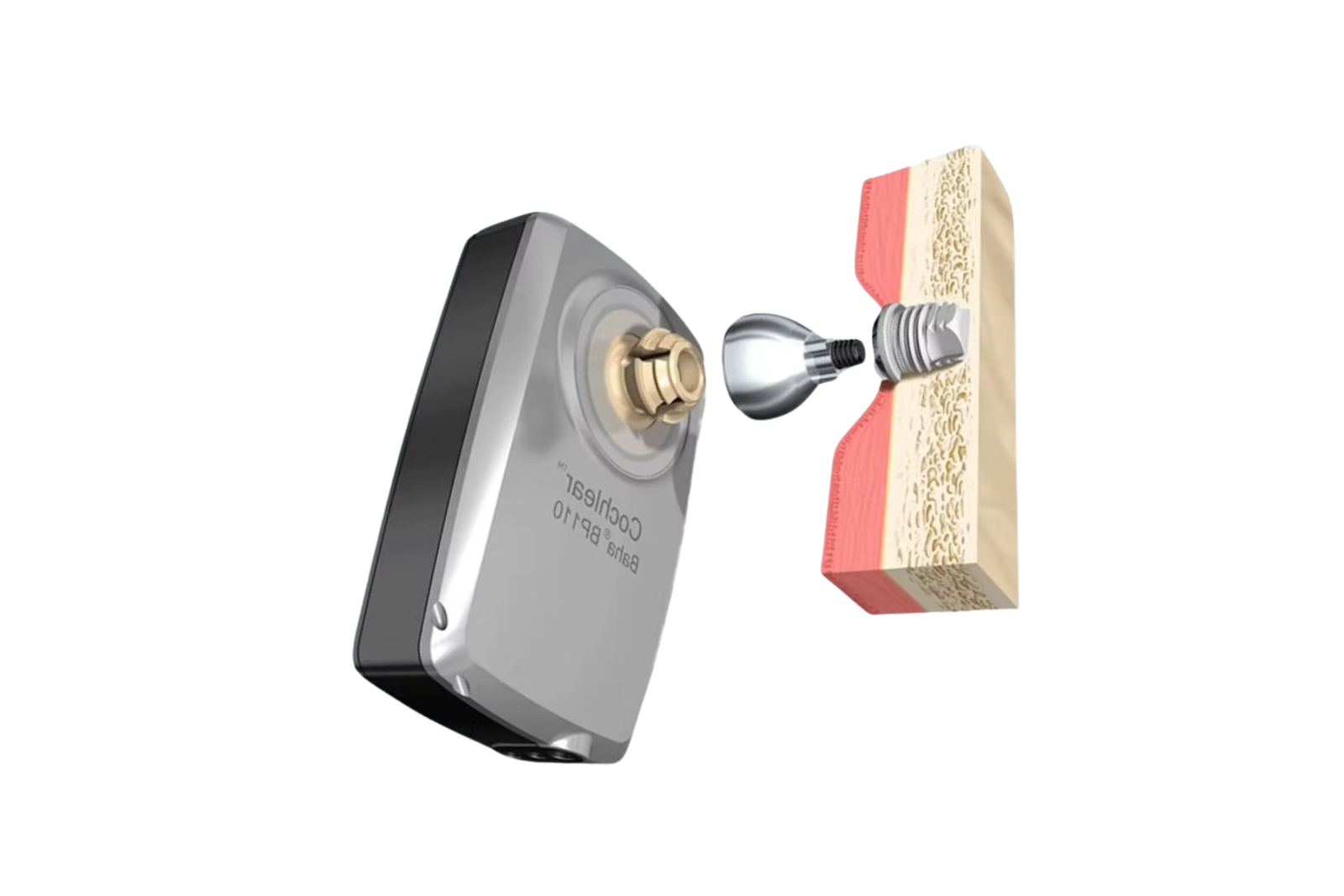 Limites des implants à ancrage osseux