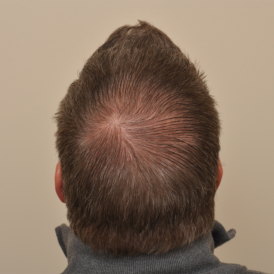 Top from behind — crown and donor area
