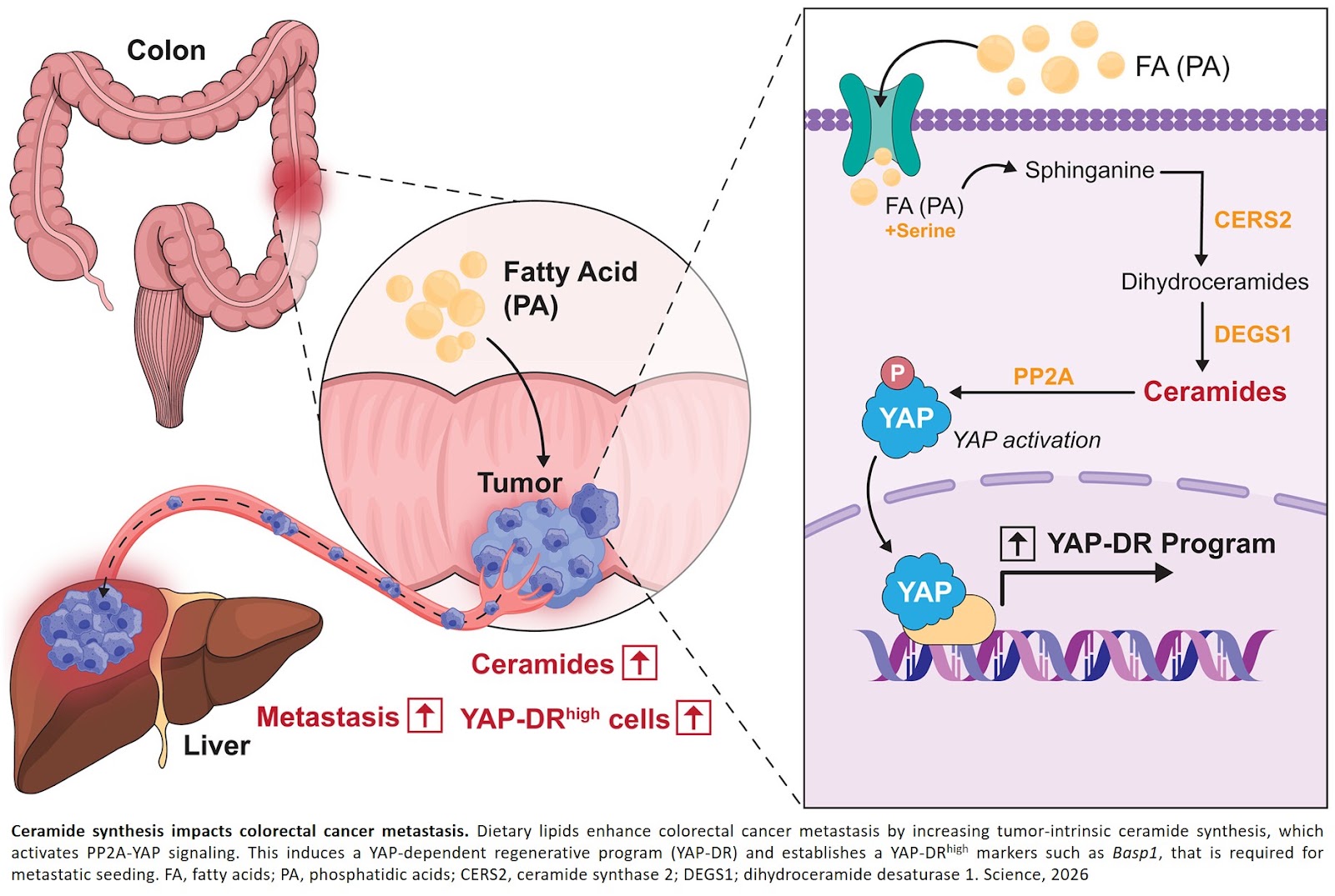 A cellular pathway that allows colorectal cancer to metastasize identified!