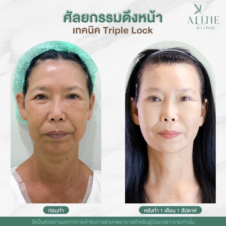 รีวิวผ่าตัดดึงหน้า ALINE Clinic