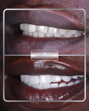 Hollywood Smile Beirut complete transformation Smile Infinity Dr Habib Zarifeh patient result case 4