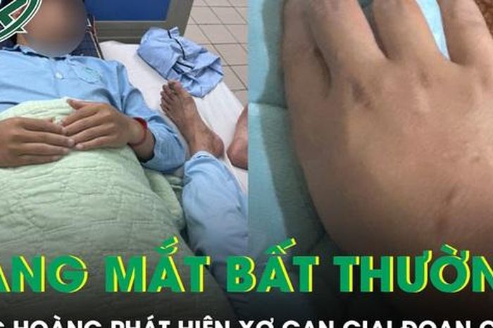 Da và mắt vàng bất thường, chàng trai 21 tuổi bàng hoàng phát hiện xơ gan giai đoạn cuối - Báo Sức Khỏe &amp; Đời Sống