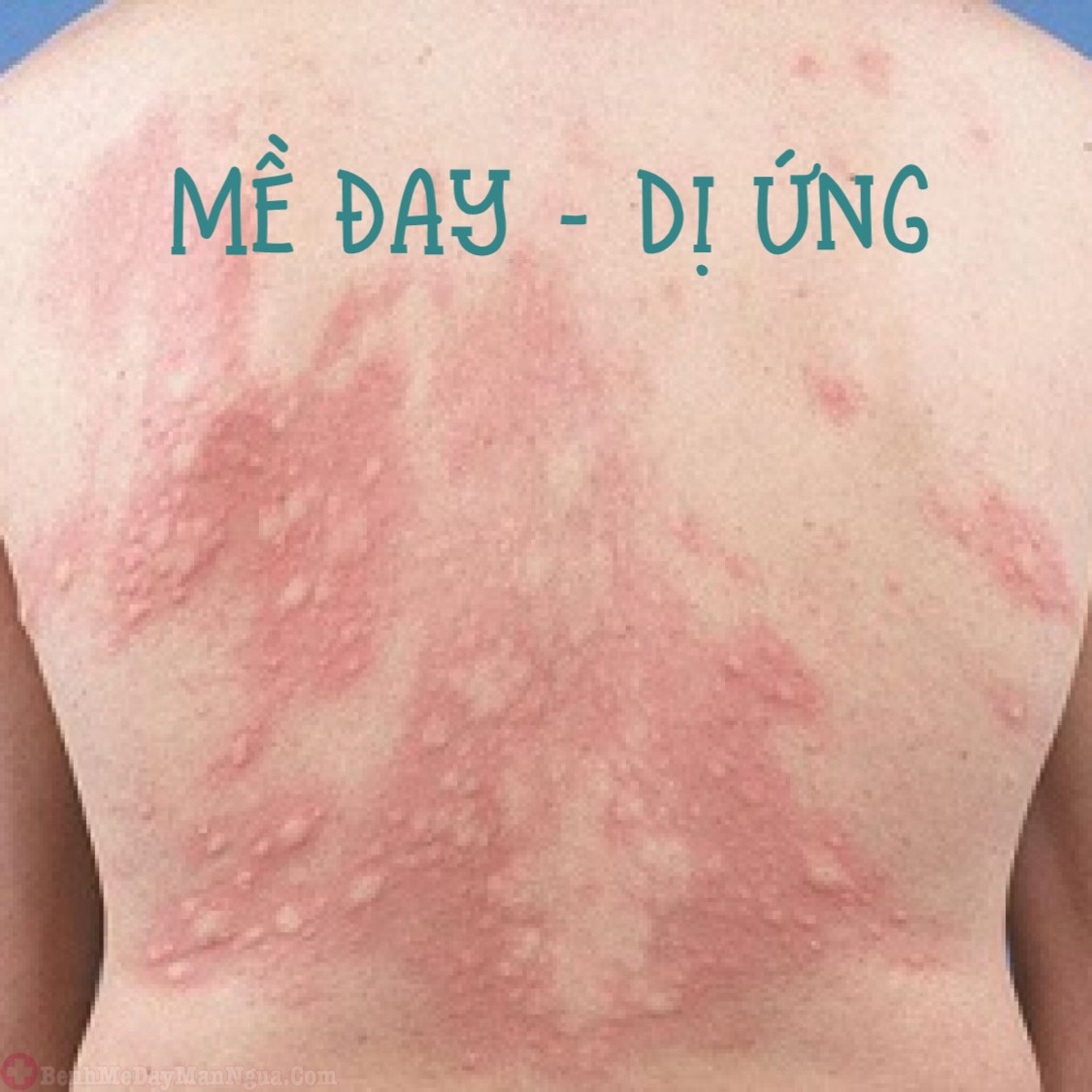 DỊ ỨNG – MỀ ĐAY