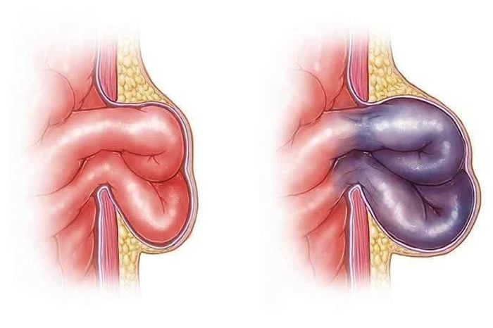 Thoát vị bẹn nghẹt, cẩn trọng tránh biến chứng nguy hiểm - Báo Tri thức &amp; Cuộc sống