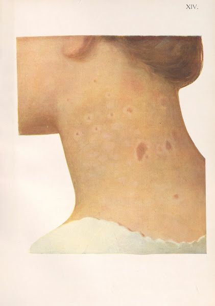 Venereal diseases  Syphilis Pl14 1908