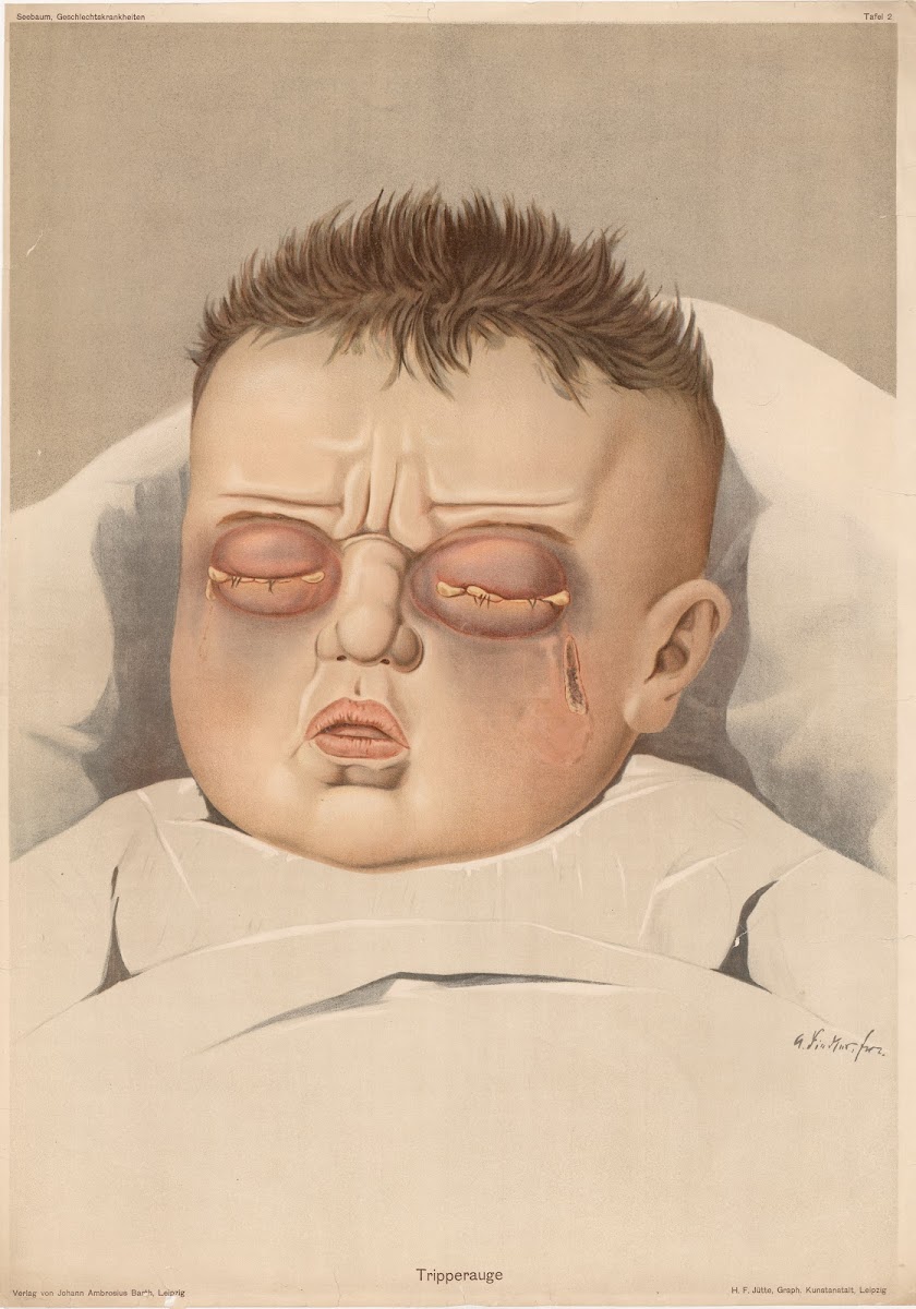 Tripperauge 1900
