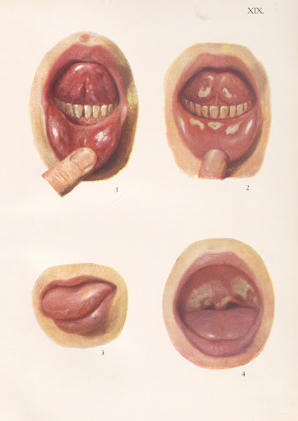 Venereal diseases  Syphilis Pl19 1908