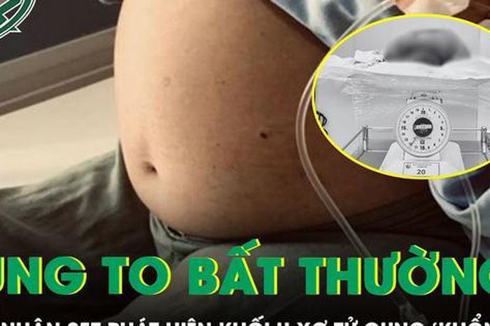 Bóc tách thành công khối u xơ tử cung 'khổng lồ' cho nữ bệnh nhân 25 tuổi - Báo Sức Khỏe &amp; Đời Sống