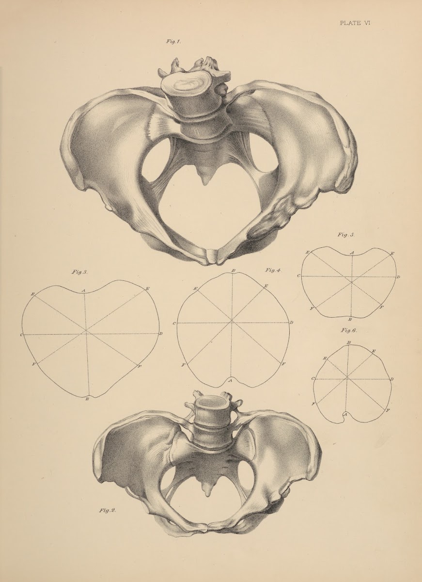 Malformation of the Pelvis 1885