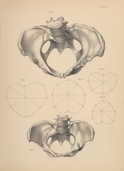 Malformation of the Pelvis 1885