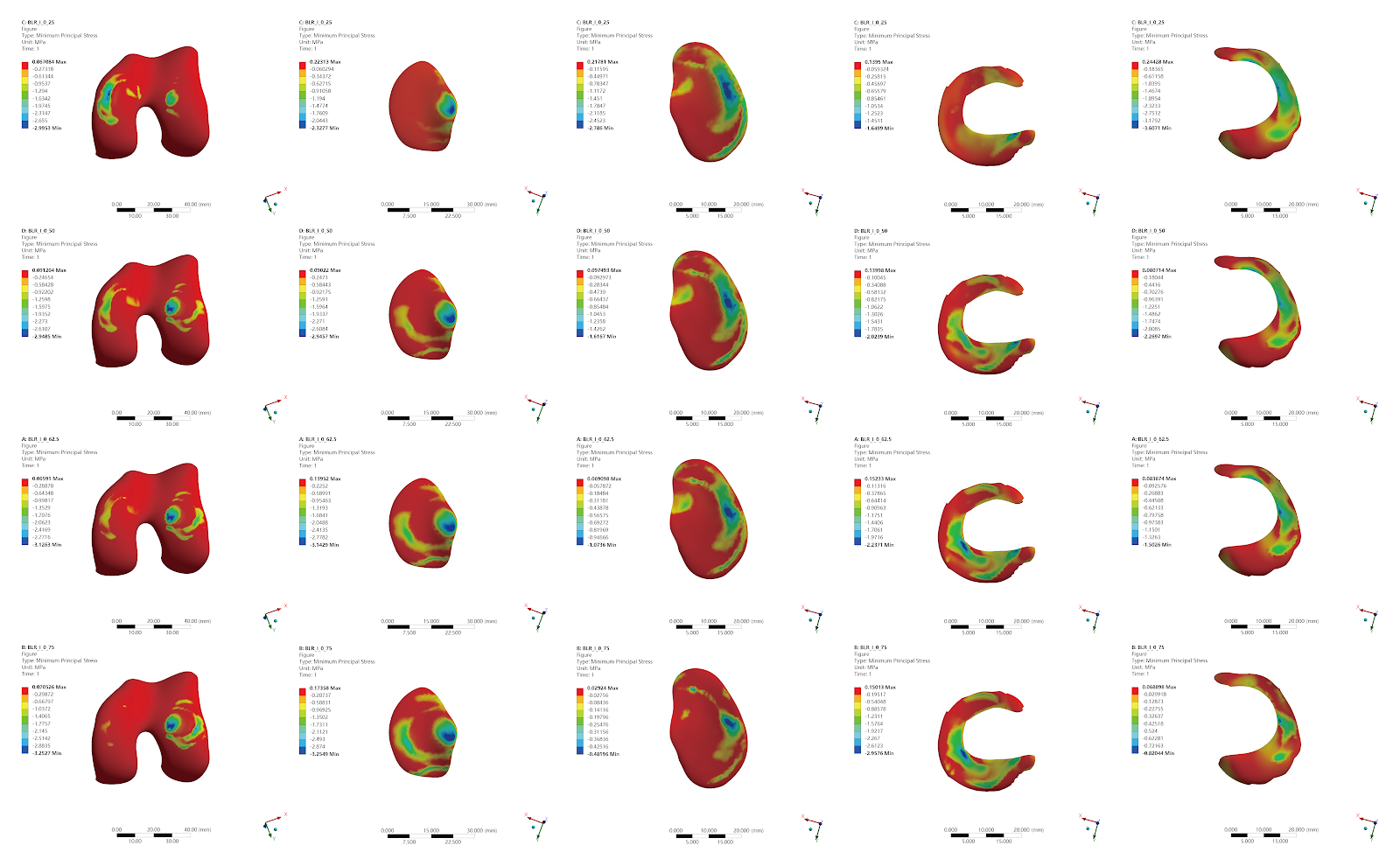 Finite element analysis of effects of opening wedge high tibial osteotomy on knee joint and internal fixation stress