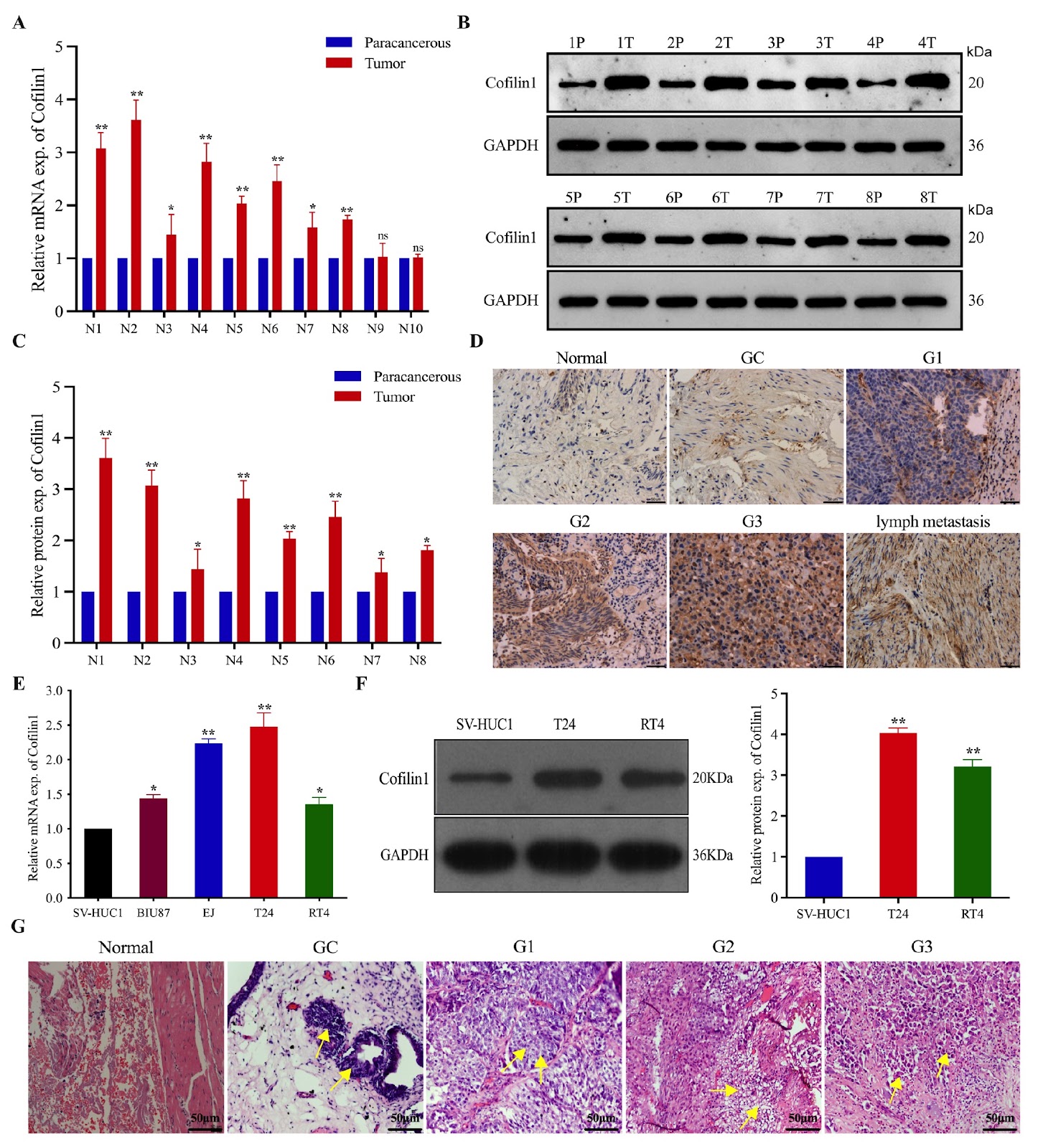 The TCF7L2/miR-206/Cofilin1 axis promotes the metastasis of bladder cancer cells by regulating the formation of invadopodia