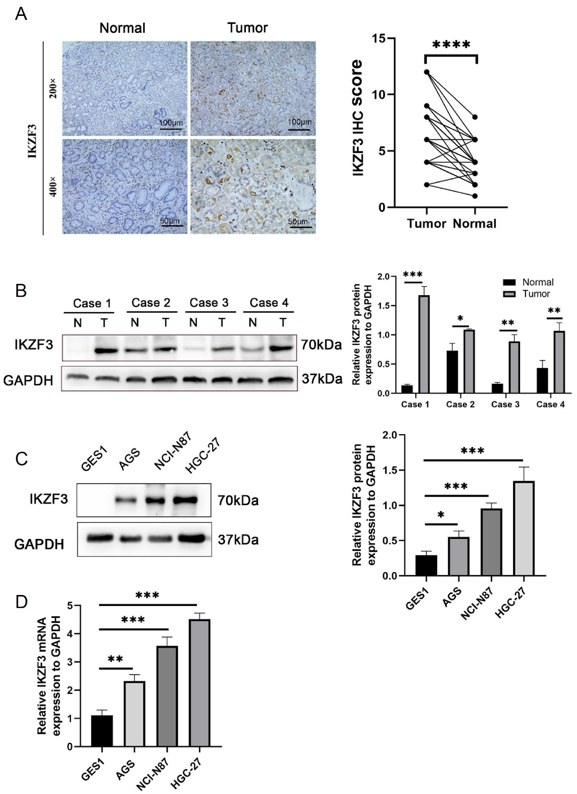 IKZF3 promotes gastric cancer progression via Hedgehog signaling activation and is targetable by SANT-1
