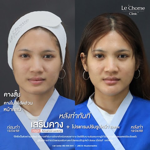 เสริมคาง (ใหม่)