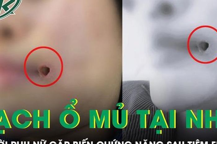 Rạch ổ mủ tại nhà, người phụ nữ gặp biến chứng nặng sau tiêm filler - Báo Sức Khỏe &amp; Đời Sống
