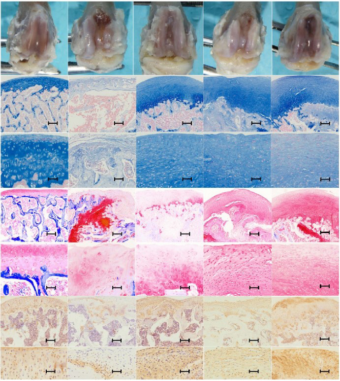 AAV-Mediated Expression of p65shRNA and Bone Morphogenetic Protein 4 Synergistically Enhances Chondrocyte Regeneration
