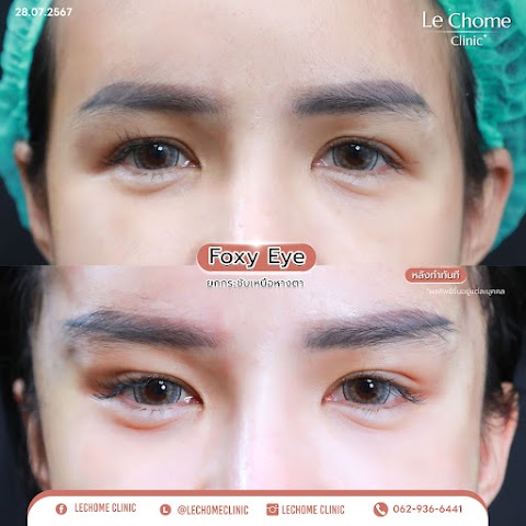 ตา 2 ชั้น