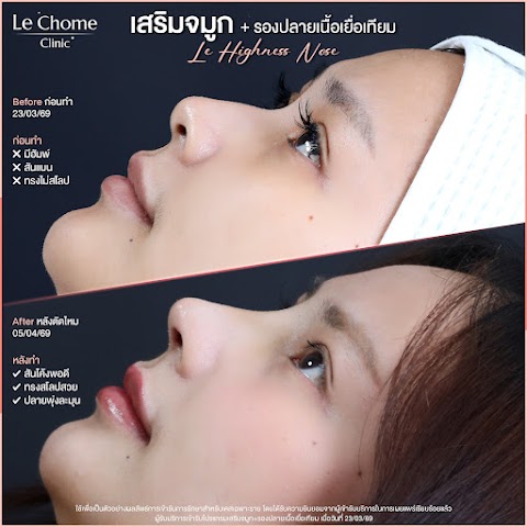 รีวิวเสริมจมูก — เสริมจมูก