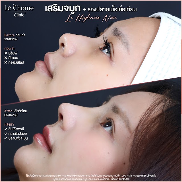 รีวิวเสริมจมูก — เสริมจมูก