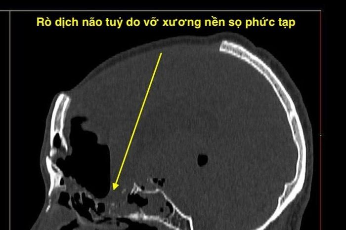 Nội soi nền sọ não vá rò dịch não tủy qua đường mũi - Báo Tri thức &amp; Cuộc sống