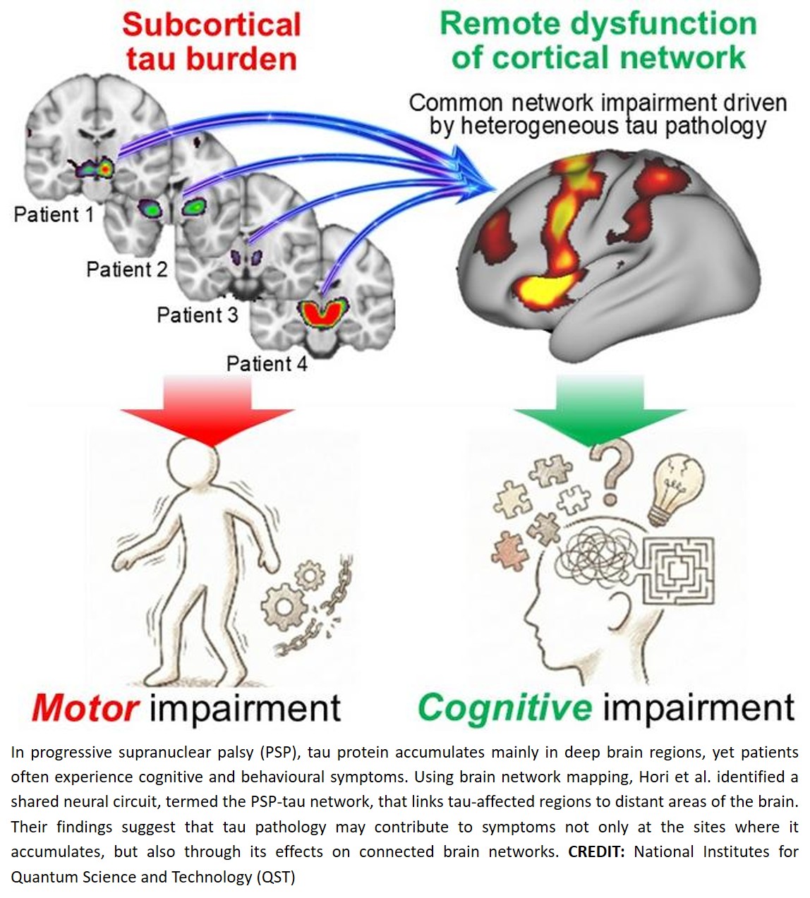 Remote network for cognitive symptoms derived from tau accumulation in progressive supranuclear palsy