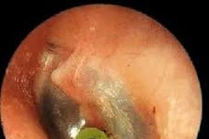 Loại viêm tai giữa không nung mủ, diễn biến âm thầm đe dọa thính lực - Báo Tri thức &amp; Cuộc sống