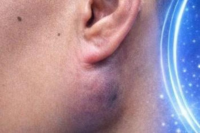 Chủ quan sưng góc hàm không đau nào ngờ u tuyến nước bọt mang tai - Báo Tri thức &amp; Cuộc sống