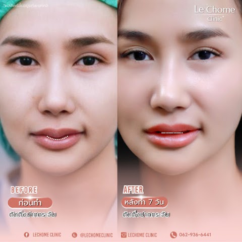 ตกแต่งริมฝีปาก