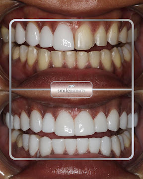 Lumineers before after Lebanon Beirut Ferrari Dental Clinic Dr Habib Zarifeh UK Britain patients 2026