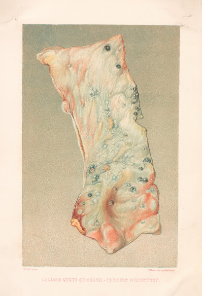 Colloid Cysts Of Colon Chronic Dysentry 1870 1888