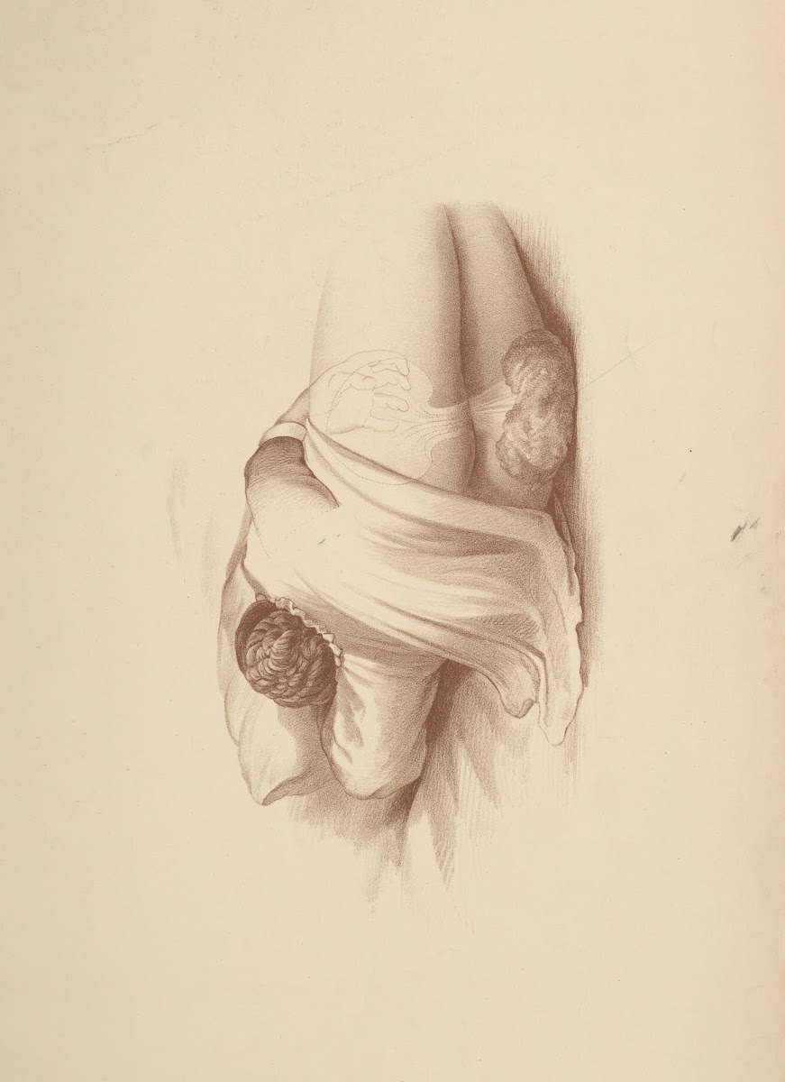 After birth by Expulsion 1885