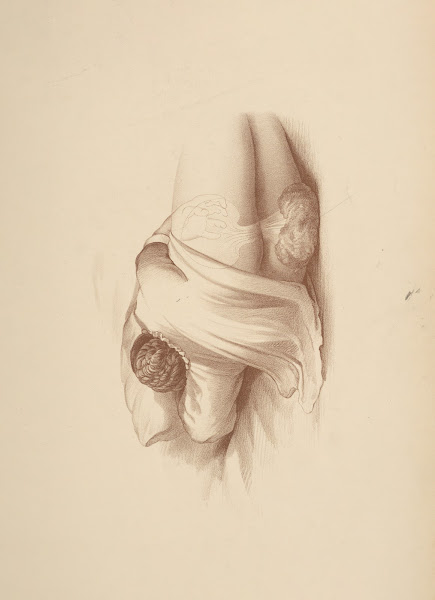After birth by Expulsion 1885