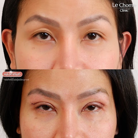 ตา 2 ชั้น