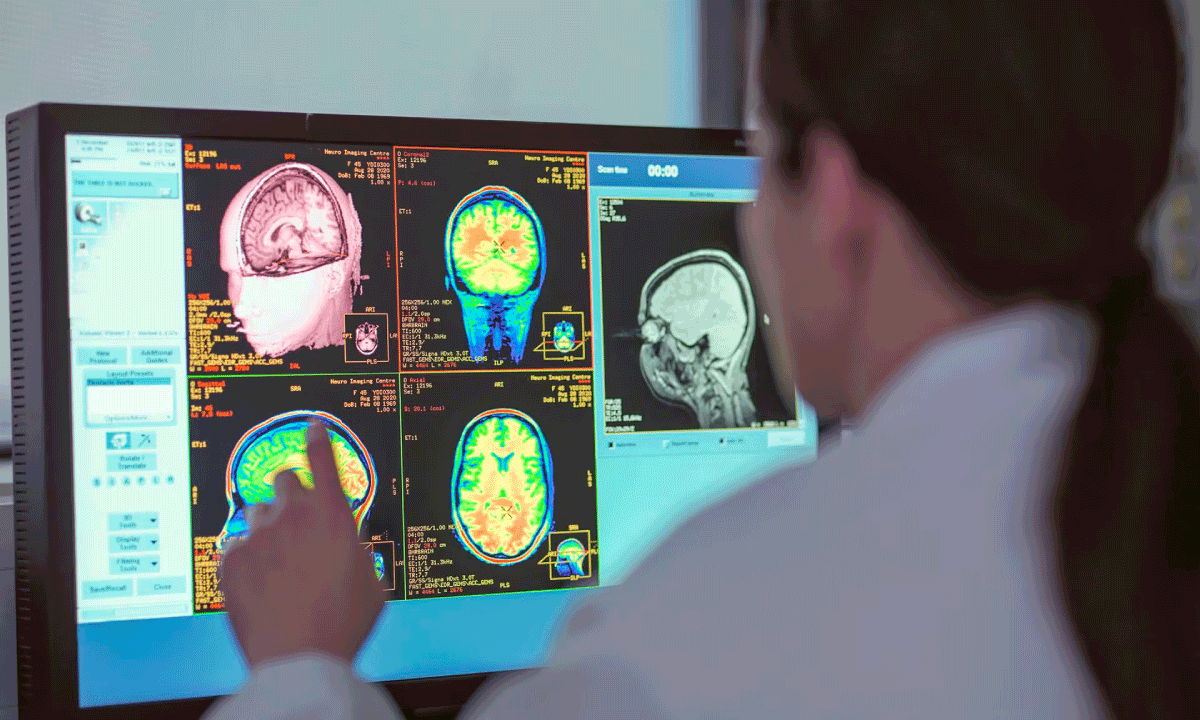 El mercado de Alzheimer desata oportunidades de inversión: terapias emergentes, diagnósticos y crecimiento proyectado