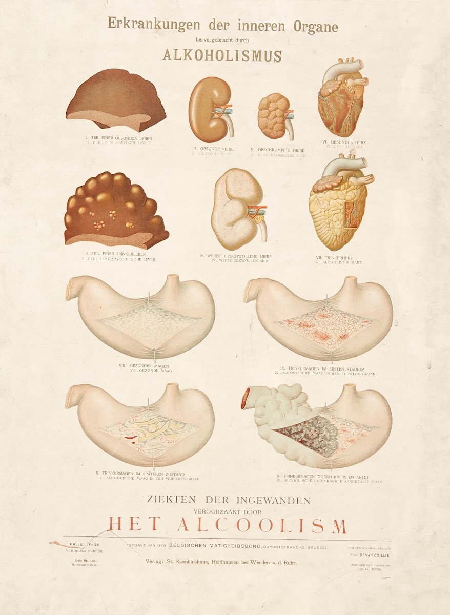 Diseases Of The Internal Organs Caused By Alcoholism 1900