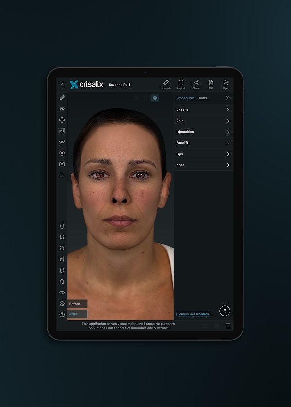 Tablette affichant l’interface de l’application Crisalix avec une simulation de visage 3D.