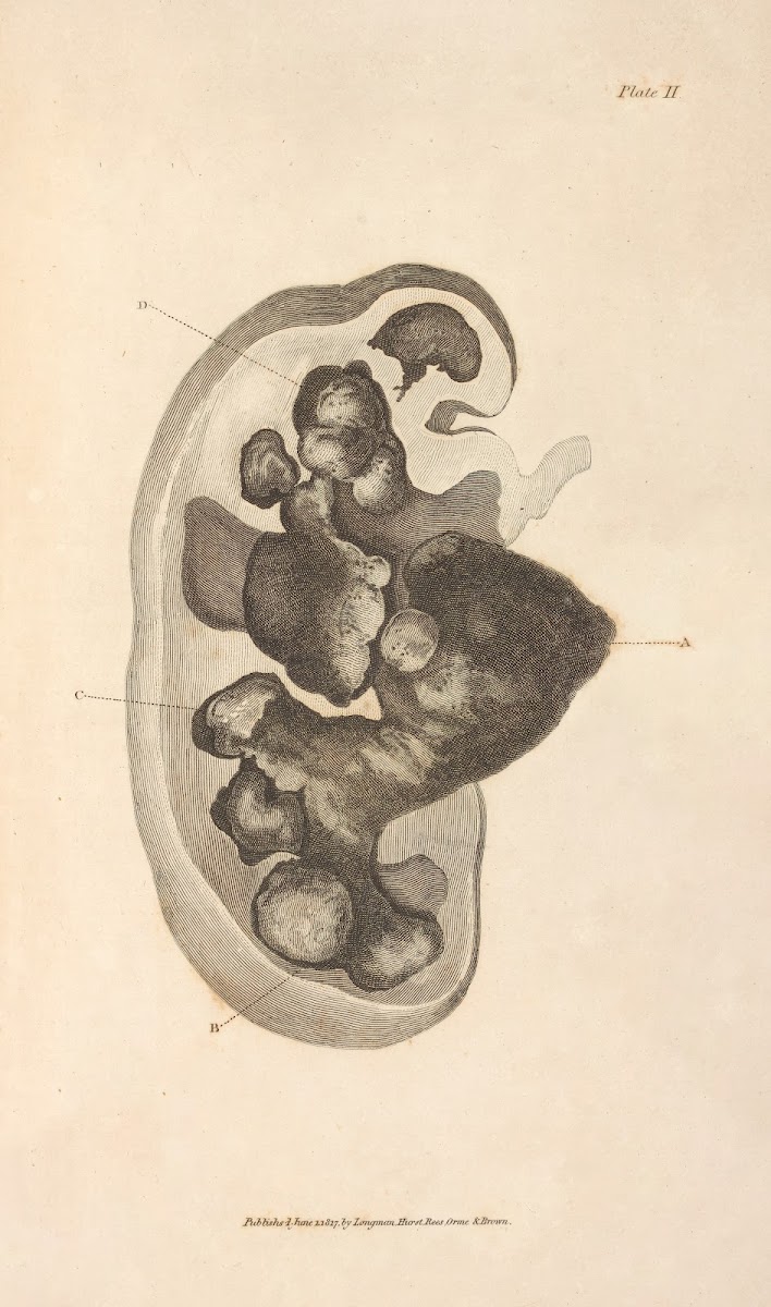 An Essay on the Chemical History and Medical Treatment of Calculous Disorders Pl