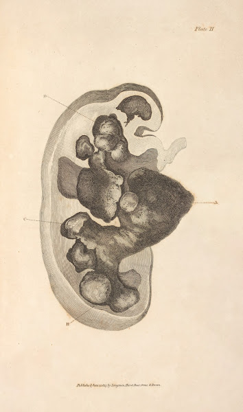 An Essay on the Chemical History and Medical Treatment of Calculous Disorders Pl