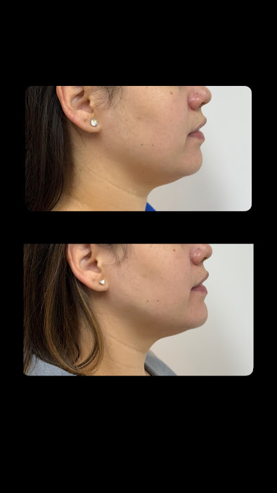 Antes e depois papada e mandíbula