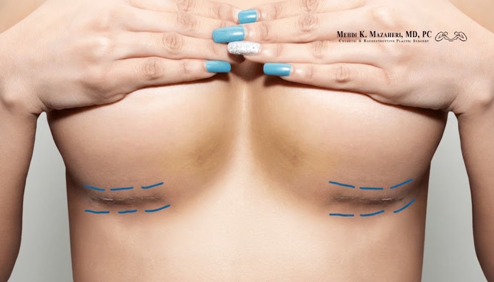 Surgical markings on the chest
