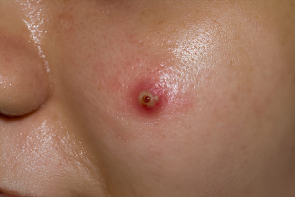 What Are Blood-Filled Pimples?