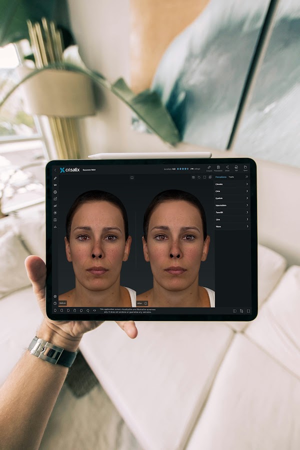 Tenir la main d’une tablette affichant l’interface de l’application Crisalix avec une simulation de visage 3D.