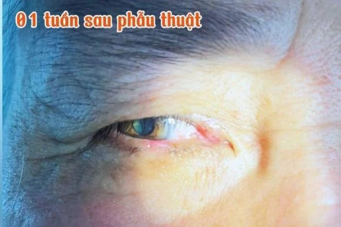 Loại bỏ u mí mắt tồn tại hàng chục năm cho cụ bà 70 tuổi - Báo Tri thức &amp; Cuộc sống