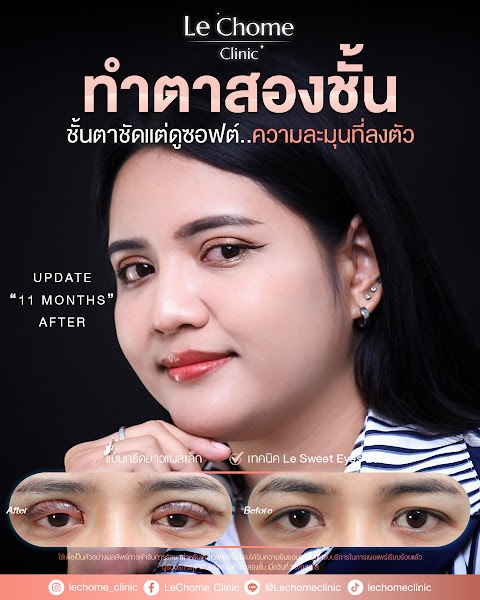 ตา 2 ชั้น