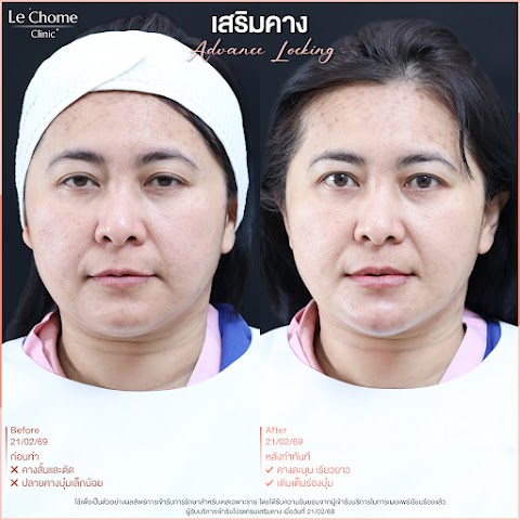 เสริมคาง