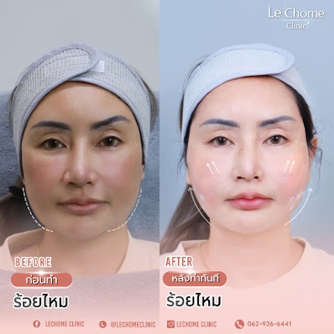 รีวิวร้อยไหม — ร้อยไหม